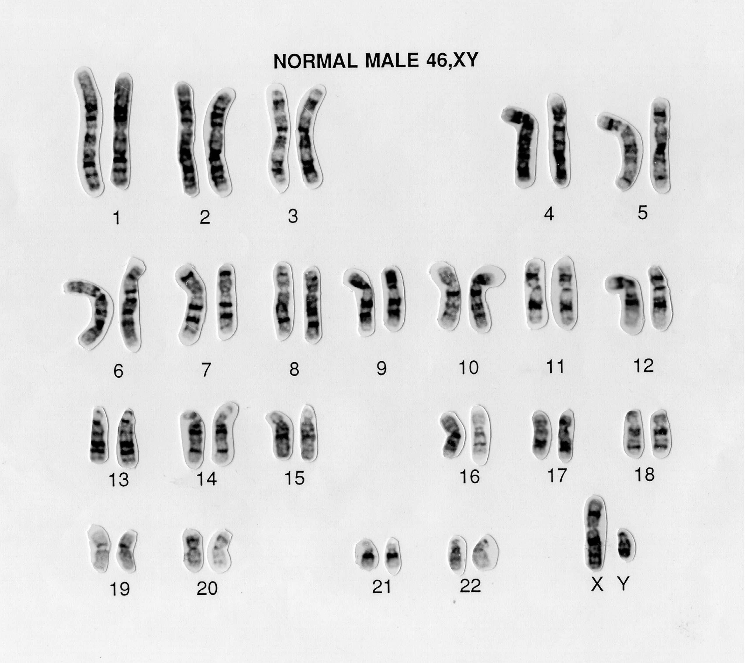 Ring Chromosomes - StoryMD