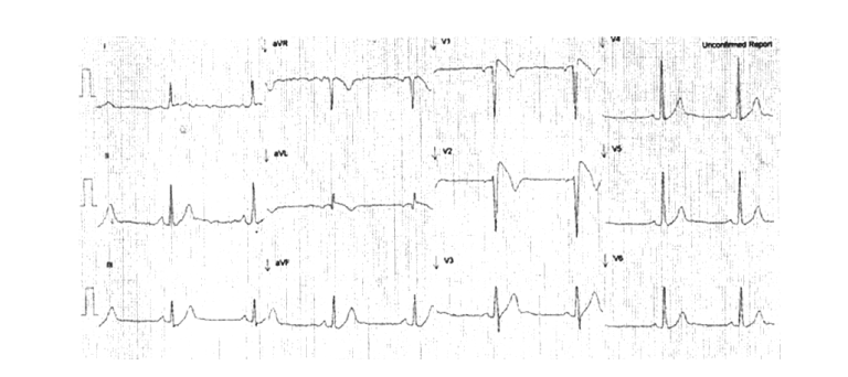 Brugada syndrome — Knowledge Hub